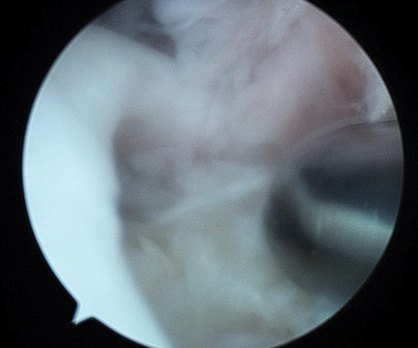 Supraspinatous tear Cresent Shaped